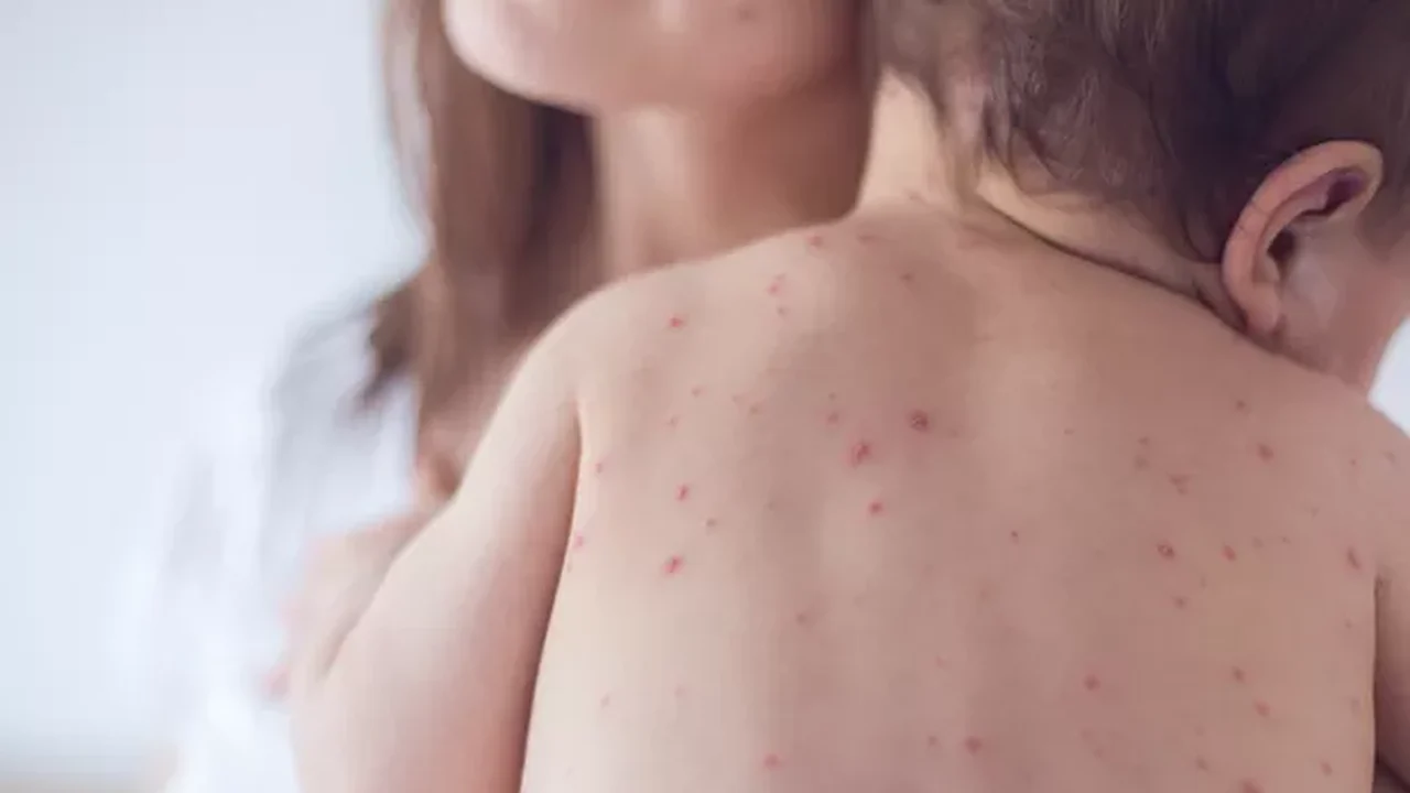 Estado de São Paulo reforça necessidade de vacinação contra o sarampo