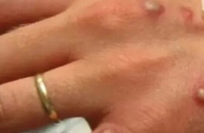 Primeiro caso de varíola dos macacos é confirmado no Brasil; Municípios devem fortalecer monitoramento