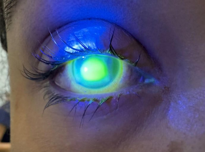 Oftalmologista do HGE alerta sobre o cuidado com os olhos durante o Carnaval