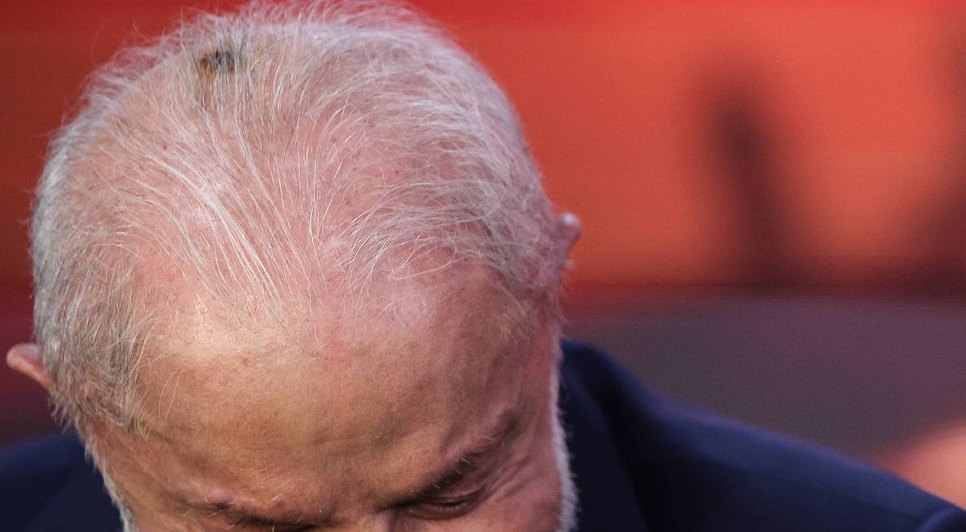 Cirugia na cabeça de Lula. Fonte: Internet