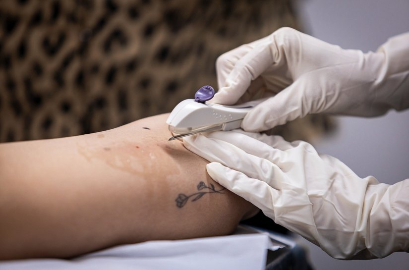 Gestão JHC marca avanço histórico na saúde da mulher com inserção gratuita do Implanon