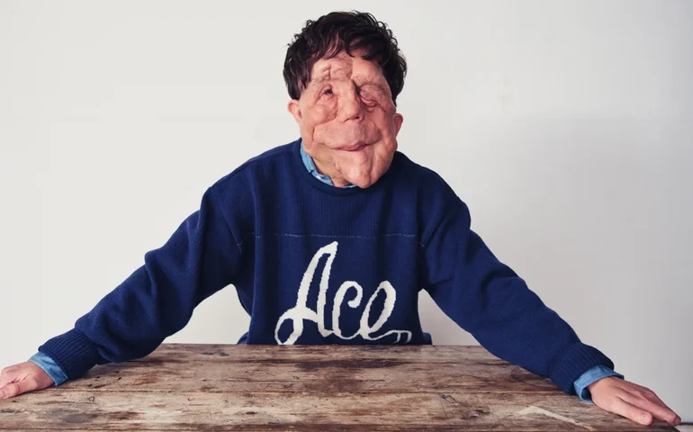 O que é neurofibromatose, condição que afeta o ator Adam Pearson