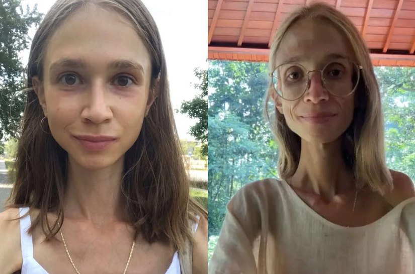 Jovem de 27 anos morre após seguir dieta extrema à base de frutas em Bali