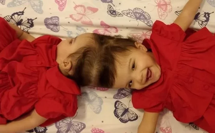 Gêmeas siamesas são separadas após cirurgia de 25 horas, em São Paulo