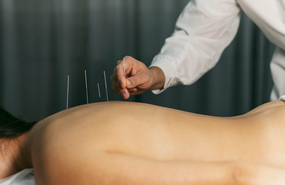 Acupuntura e alívio da dor: entenda como essa técnica milenar atua no corpo