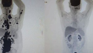 car-t-cancer-30052023110413730 / Foto: Portal R7