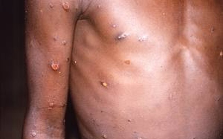 OMS recoloca mpox, antiga varíola dos macacos, como uma emergência global