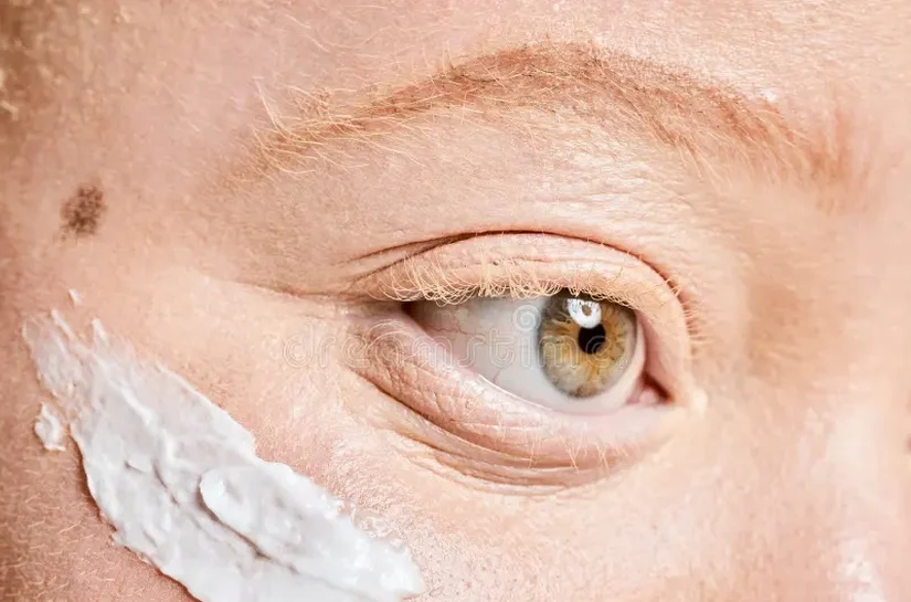 Maveió garante protetor solar gratuito para pessoas com albinismo