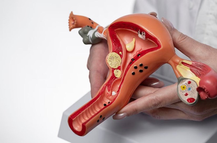 Endometriose: você está atenta aos sinais?