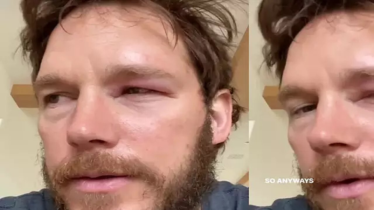 Chris Pratt é picado por abelha e mostra olho inchado em vídeo
