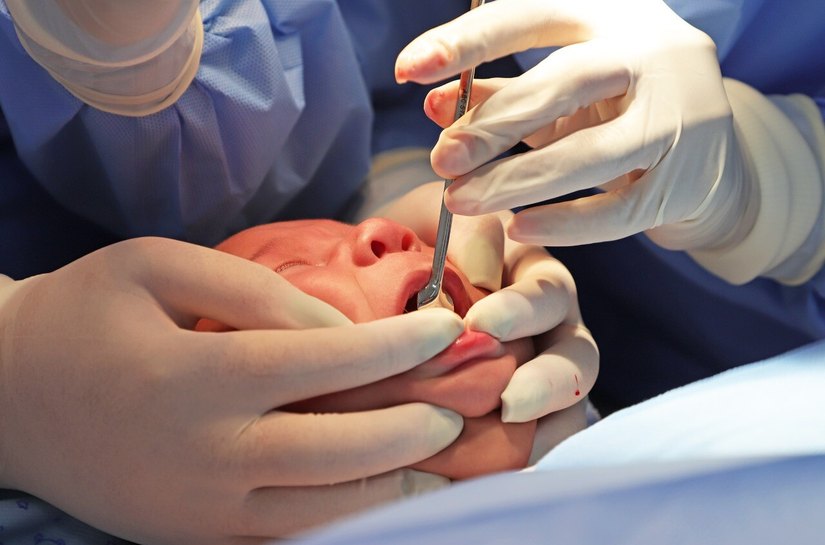 Frenectomia: conheça a cirurgia que voltou a popularizar após caso de filho da influenciadora Viih Tube