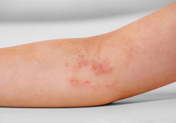 Pesquisa usa IA para tirar dúvidas sobre dermatite atópica