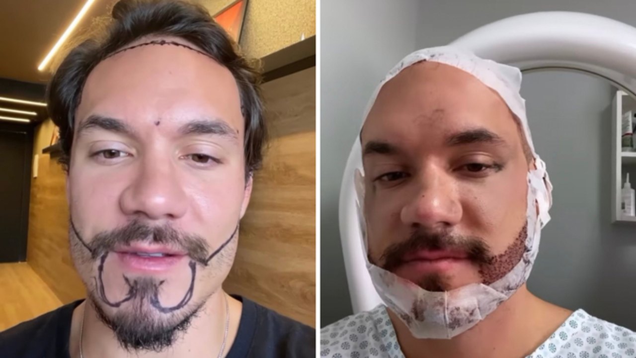 Ex-BBB Eliezer realiza transplante de cabelo e barba para ‘corrigir falhas’
