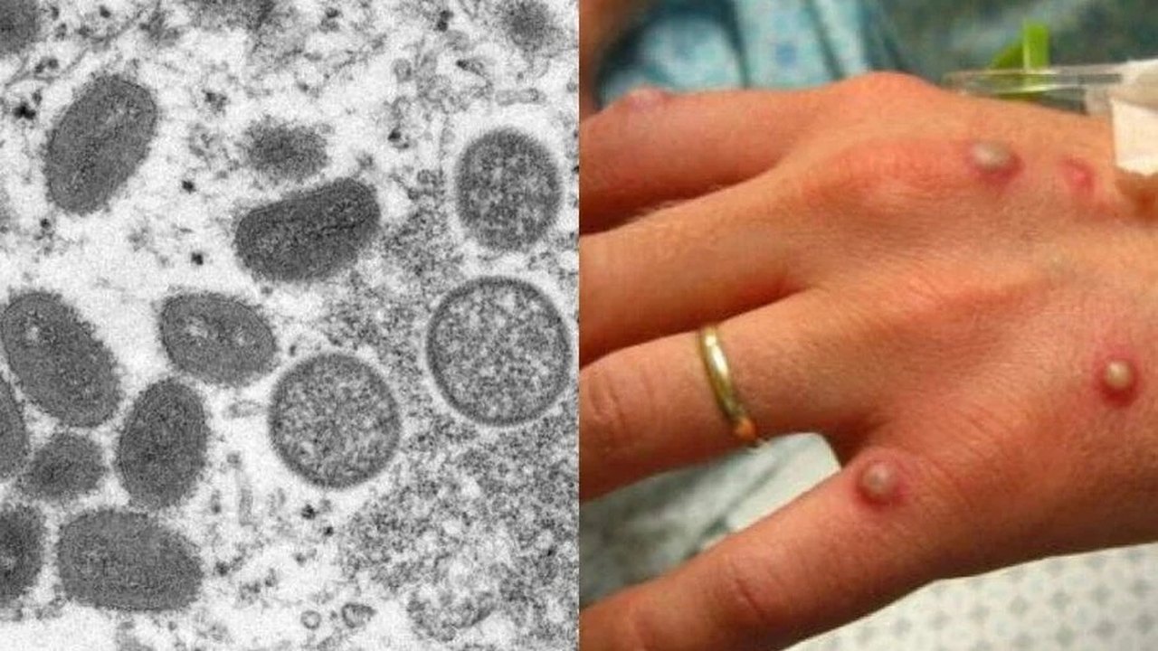 Varíola dos macacos: entenda como ocorre a transmissão e os sintomas da doença