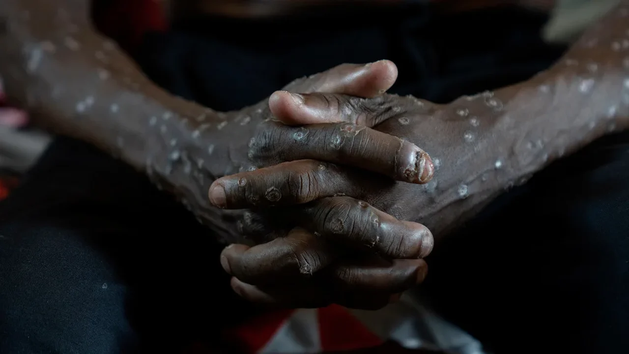 Congo afirma que seu surto de mpox terminou após 2 anos e mais de 2.200 mortes suspeitas