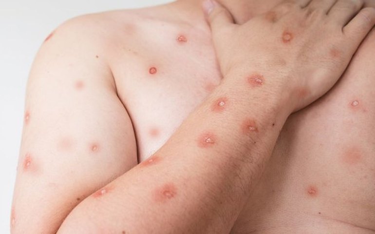 Mpox: entenda por que é difícil avaliar o perigo da doença