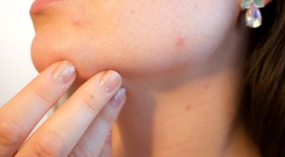acne-1606765_1280.jpg / Foto: EBC