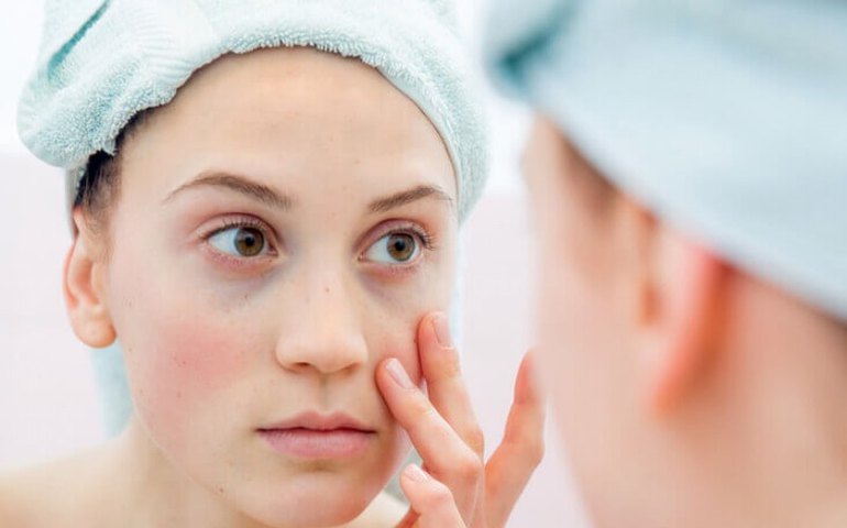 Tratamentos trazem bem-estar aos pacientes com lúpus, que não tem cura