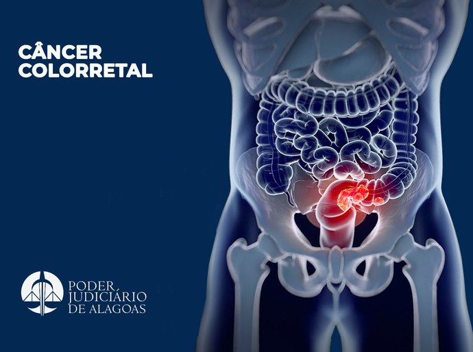 Médico do TJAL explica os sintomas e tratamento do câncer colorretal