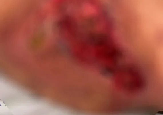 Dentista é presa em Arapiraca por aplicar silicone industrial e causar lesões graves em pacientes