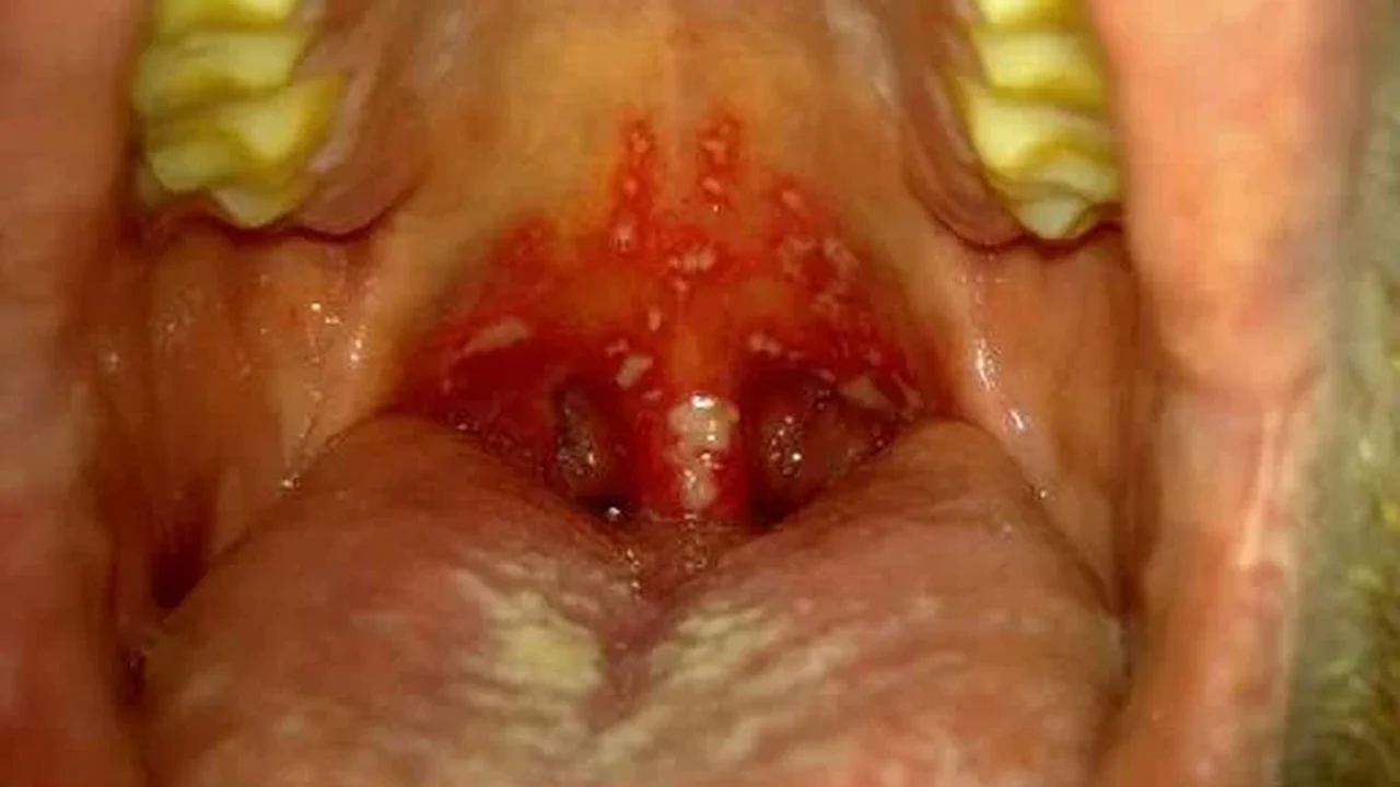 Estomatite: o que é essa inflamação que provoca feridas dolorosas na boca?