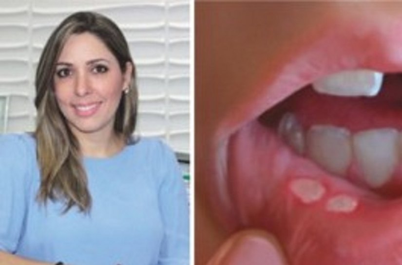 Aftas têm tratamento, mas em alguns casos pode sinalizar câncer oral