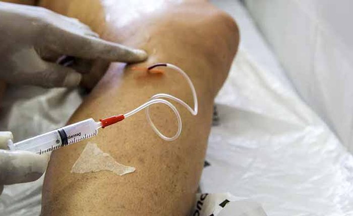 SBACV analisou dados de todo o país do Ministério da Saúde SBACV analisou dados de todo o país do Ministério da Saúde