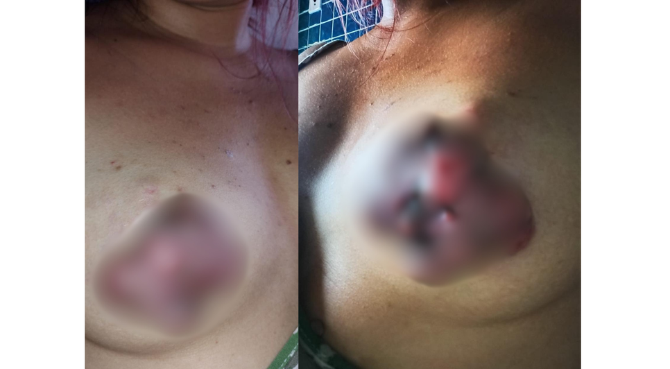 Com estágio avançado, mulher espera atendimento há quase um ano / Foto: Cortesia