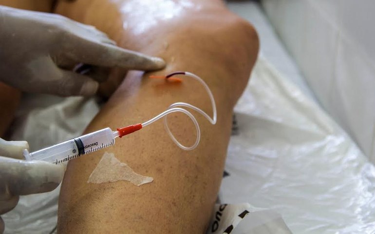 A cada dia, 145 mulheres são internadas para tratar varizes