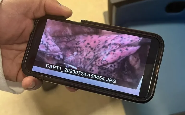 Lutador de 20 anos perde parte do pulmão após uso de vape; veja foto de como ficou o órgão