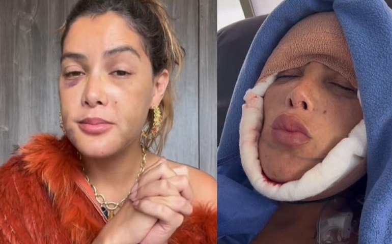 Marcella Maia faz cirurgia de emergência no rosto: 'Vítima de silicone indústrial'