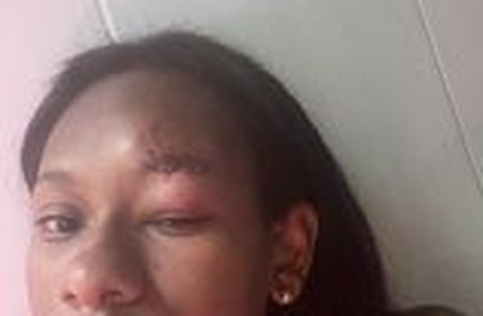 Estudante é acusada injustamente e agredida com mordidas no rosto em Carmópolis