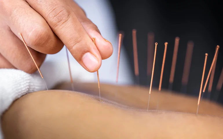 Regulamentação do exercício profissional de acupuntura segue para sanção
