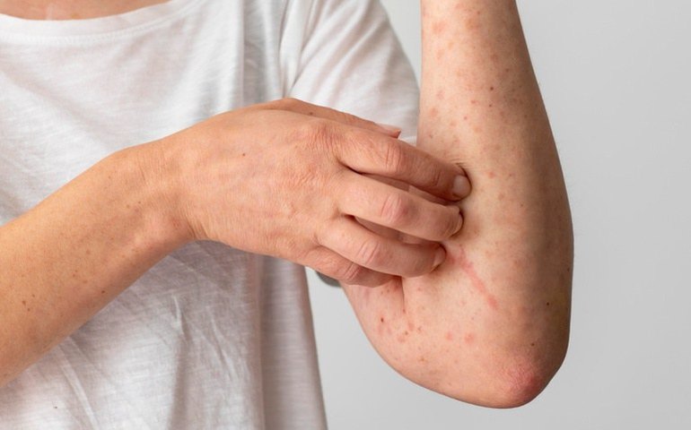 Dobra o número de pessoas que sofre com alergias alimentares; entenda o motivo 