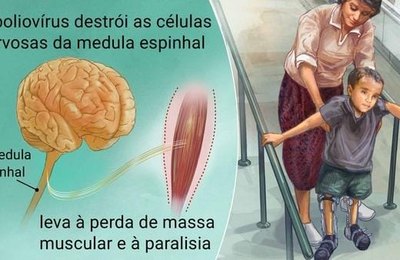No Dia Mundial de Combate à Poliomielite, o alerta é para queda na cobertura vacinal