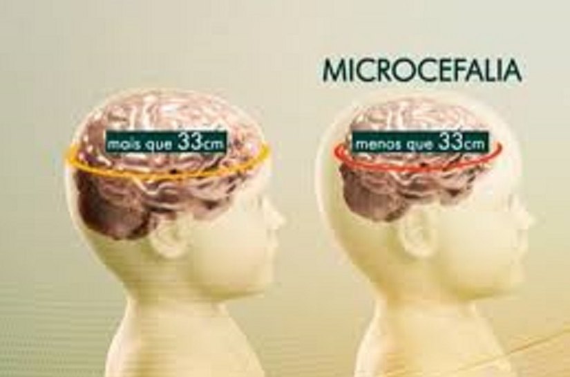 Responsáveis por bebês com microcefalia terão direito a auxilio