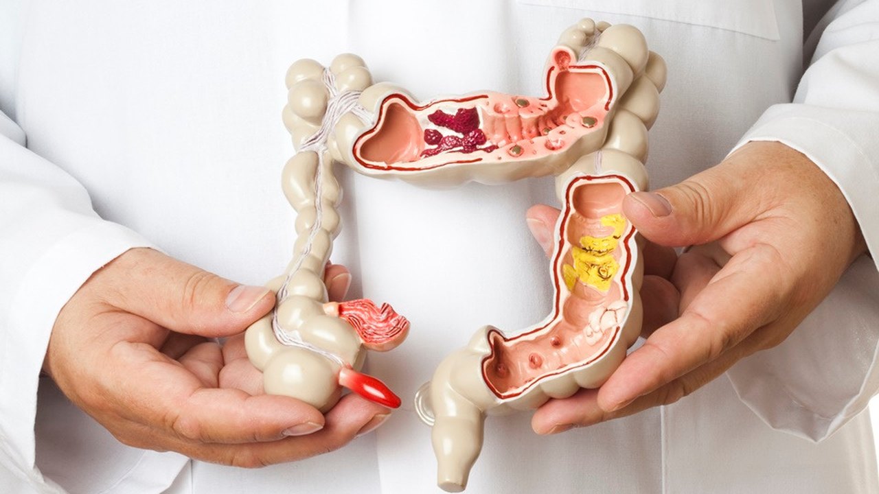 Câncer de intestino é o terceiro de maior incidência  no Brasil