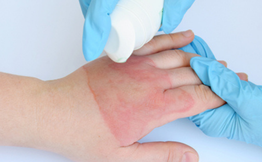 Prevenção de queimaduras: saiba como evitar acidentes domésticos