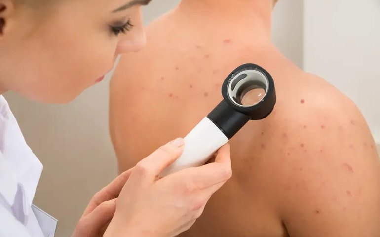 Câncer de pele: vacina pode reduzir em 44% risco de morte, diz teste preliminar