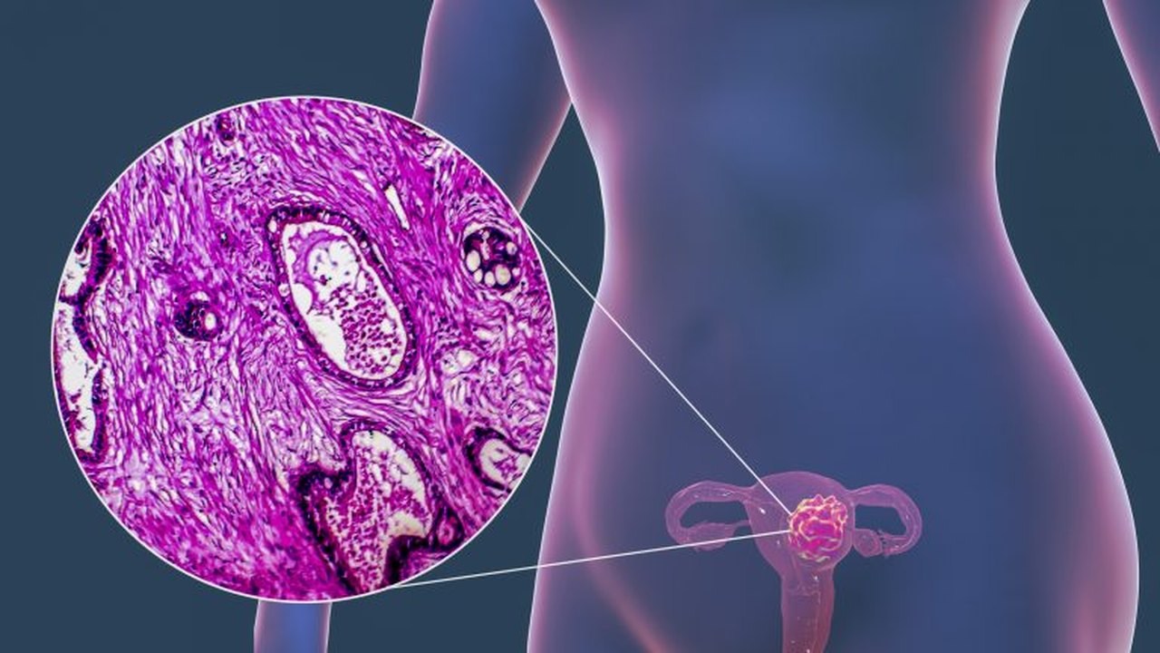 Câncer de colo de útero: teste molecular de HPV, que vai substituir Papanicolau no SUS, identifica quase 4 vezes mais casos da infecção