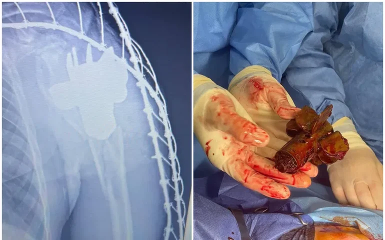 Médicos retiram fragmento de mina terrestre do corpo de soldado ucraniano