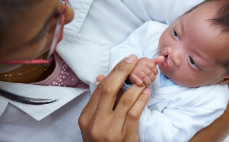 Lei obriga SUS a oferecer tratamento completo de lábio leporino