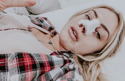 Monick Camargo faz cirurgia plástica no nariz e explica: "Tinha um ossinho que me atrapalhava"