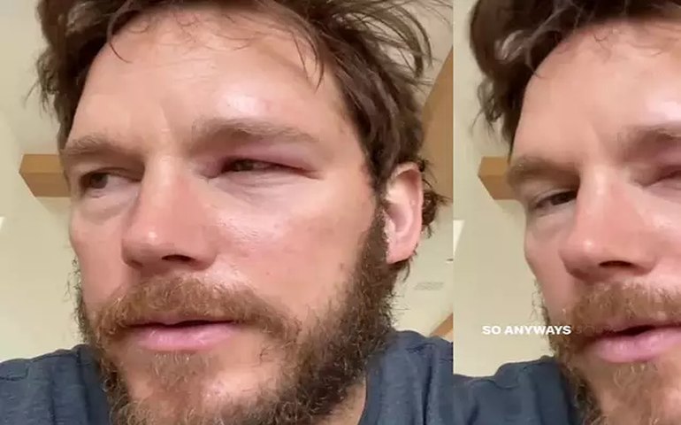 Chris Pratt é picado por abelha e mostra olho inchado em vídeo