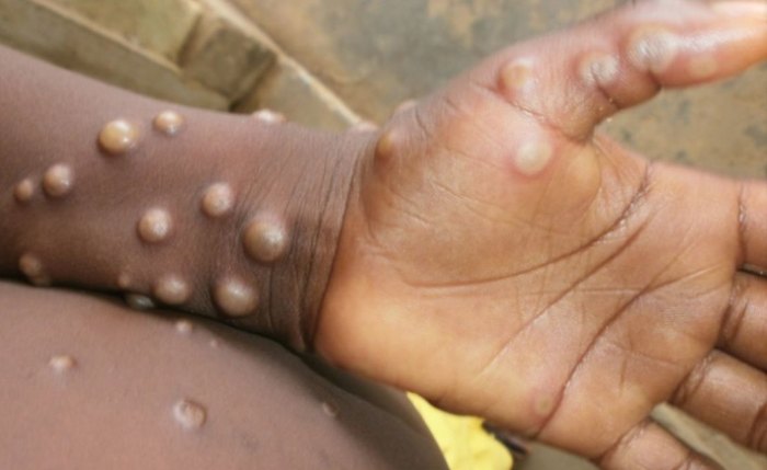 Mpox: transmissão por meio do contato com pessoas infectadas, materiais contaminados ou animais silvestres infectados