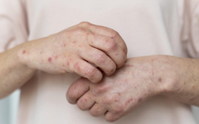 Arapiraca confirma primeiro caso de Varíola dos Macacos