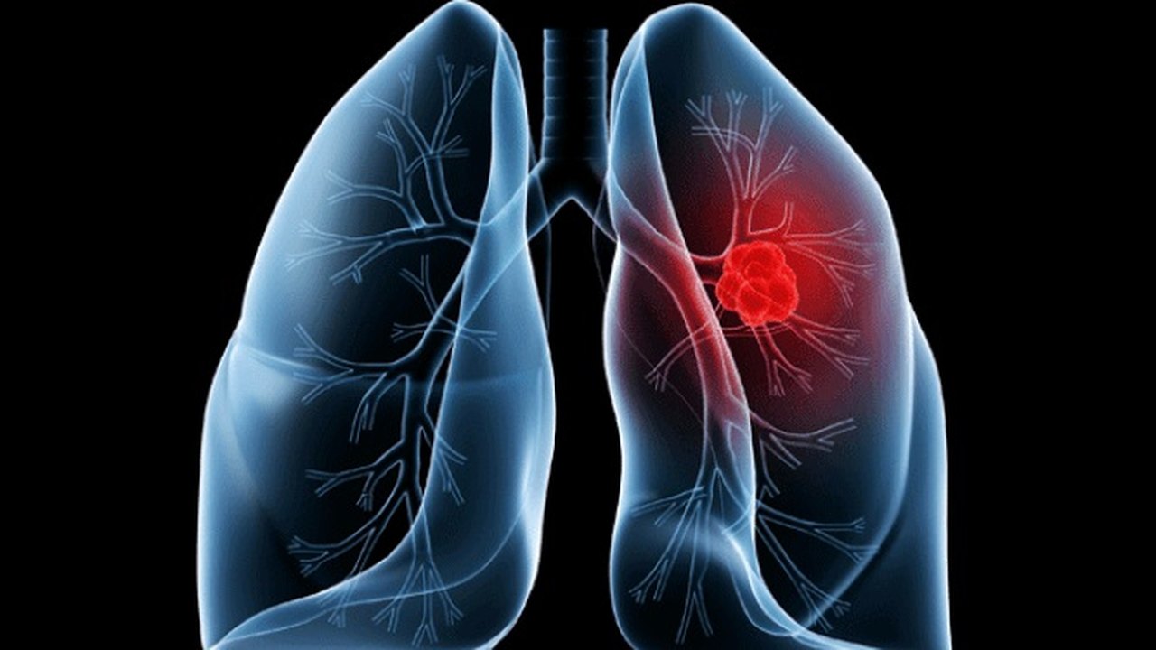 Saiba o que é adenocarcinoma pulmonar, câncer que atinge o Papa Leão