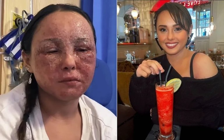 Eczema causa perda de visão temporária em jovem da Irlanda