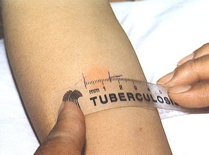 Saúde de Maceió realiza exames para diagnóstico de tuberculose