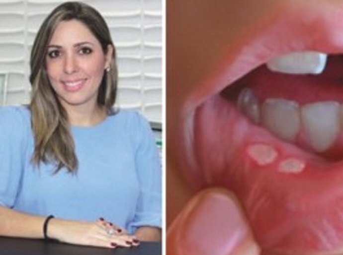 Aftas têm tratamento, mas em alguns casos pode sinalizar câncer oral